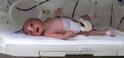 Bebeğin karnından 1 kilo 300 gram kitle çıkarıldı